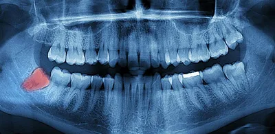 Нужно ли удалять зубы мудрости | Рекомендации стоматолога по удалению  восьмерки