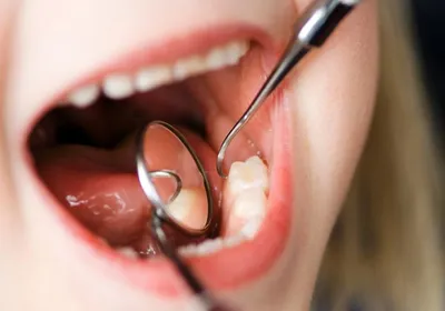 В каких случаях удаляют зуб мудрости? 📌 если моляр прорезывается не до  конца. 📌 зуб растет под наклоном, упираясь в щеку или язык. 📌… | Instagram