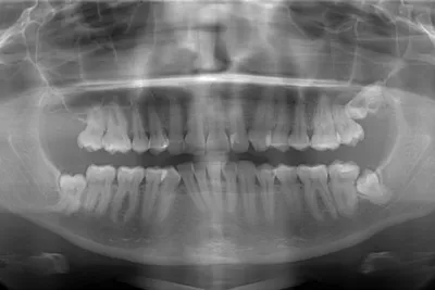 Зуб мудрости растет в щеку: симптомы, фото и что делать