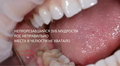 Перикоронит зуба мудрости: симптомы заболевания, лечение воспаления  капюшона десны, удаление
