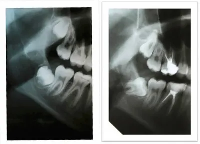 Зубы мудрости: зачем нужны, симптомы роста восьмерок, осложнения при  прорезывании | ✓Стайл-С: понятная стоматология |Москва — Отрадное| | Дзен