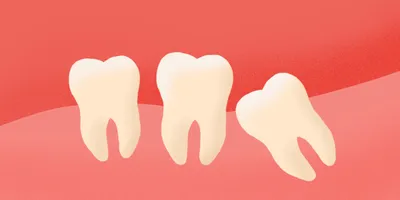 Поехали\" соседние зубы, после удаления зуба мудрости - форум Стоматология.Су