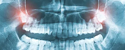Сага о стоматологии. Глава 32. Нужно ли удалять зубы мудрости? | Пикабу