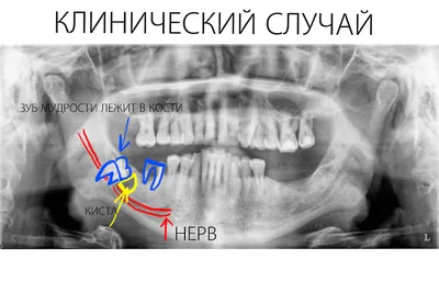 Ответы Mail.ru: Вросший в щеку зуб мудрости, разве не причина его удалить?