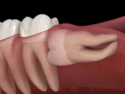 Особенности удаления зуба при помощи ультразвука