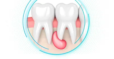 Киста зуба что такое, симптомы, способы лечения