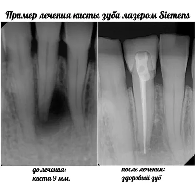 Лечение кисты зуба Стоматология №2 в Ижевске