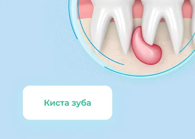 Киста зуба | Блог | Стоматология Eurodental