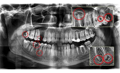 Удаление кисты зуба без удаления, цена лечения в Москве в стоматологии  Smile-at-Once