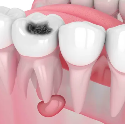 Лечение кисты зуба лазером. Современный и эффективный метод