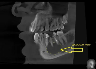 Киста после удаления зуба: кто виноват и как лечить заболевание | Dental Art