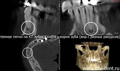 Лечение кисты зуба в Москве, описание методов и цены | «Вита-Стом»