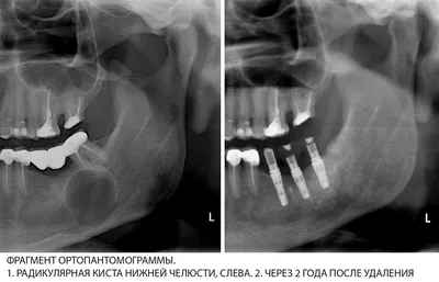 Киста зуба. Цистэктомия.