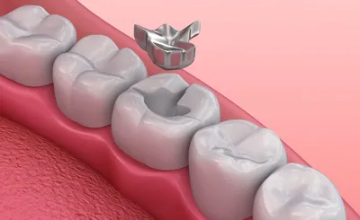 Плюсы и минусы зубных вкладок - Семейная стоматология «Smileland»