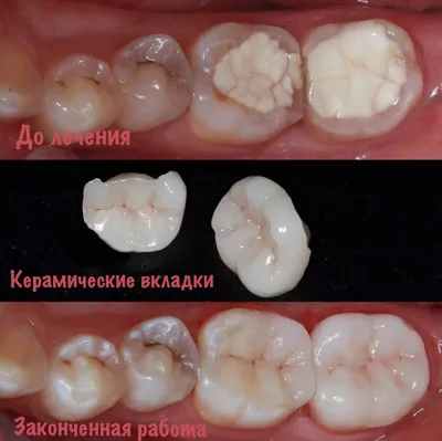 Керамические вкладки — ВестМедСервис — стоматология в Бресте