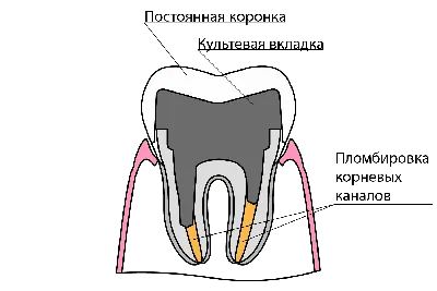 Вкладка на зуб CEREC вместо металлической вкладки, преимущества вкладки  Cerec