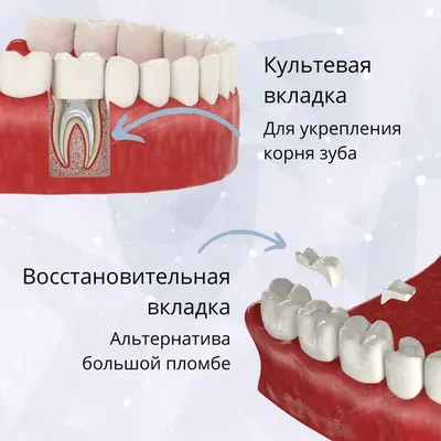 Зубные накладки и вкладки | Ateities odontologijos klinika