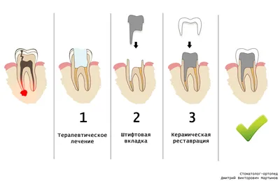 Вкладка на зуб