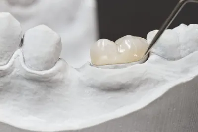 Зубные вкладки на зубы вместо пломбы: микро протез, который ставится в зуб,  восстанавливая разрушенную часть