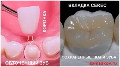 Вкладка на зуб в Минске, зубная вкладка при протезировании под коронку