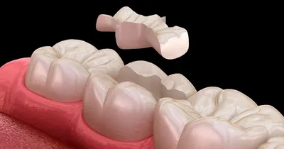 Зубные вкладки – когда устанавливать, из каких материалов изготавливаются,  преимущества и недостатки.
