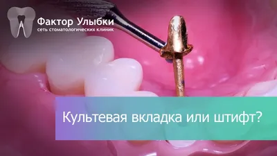 Пломбировка зуба или установка вкладки? | Альянс бьюти-ортопедов, Москва