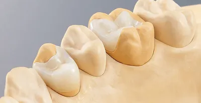Установка керамической вкладки на зуб в Уфе | Стоматологическая клиника  «Маэстро»