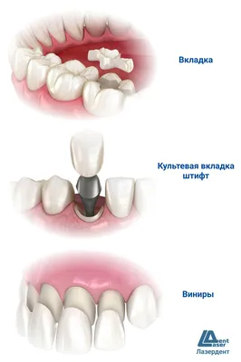 Установка культевой вкладки в стоматологии «Фактор Улыбки»