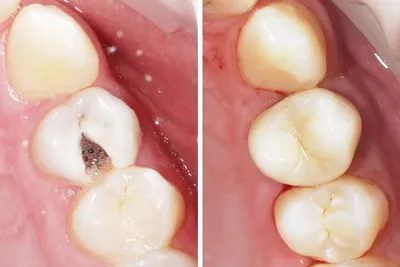 Керамические вкладки быстро набирают популярность как эффективный метод  восстановления поврежденного зуба. | SMAGA dental clinic