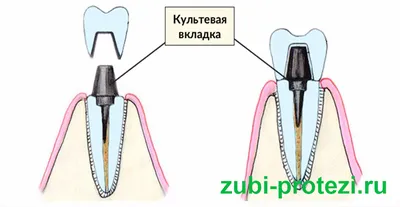 Лечение и восстановление зуба | Стоматология в Запорожье Dental Studio