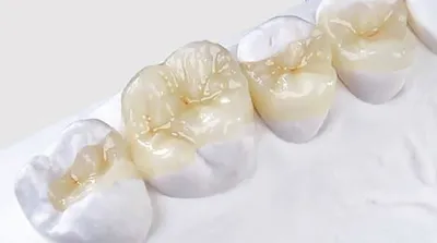 Керамическая вкладка на зуб: что это такое, восстановление зуба  цельнокерамической вставкой, плюсы и минусы
