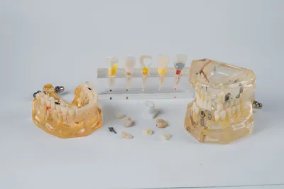 Зубные вкладки под коронку установка в Москве, цены в стоматологии  Аристократ Дент
