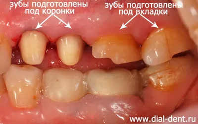 Культевая зубная вкладка на штифтах - методы установки, виды, особенности