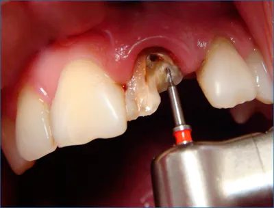 Культевая вкладка под коронку – что это такое, как делают, фото и установка  штифтовой культевой вкладки в зуб