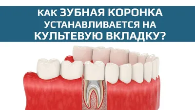 Коронки на зуб в Москве: цены, фото протезирования зубов в стоматологии  Династия