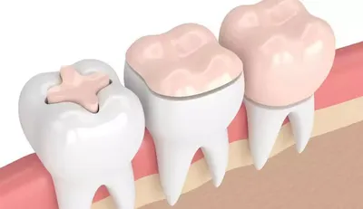 Зубные вкладки стоматологической клинике | ВАО ДЕНТ