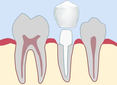 Сколько стоит восстановление зуба под коронку? Культевая вкладка. Пломба со  штифтом - Видео - Блог | Стоматологическая клиника Не Болит!