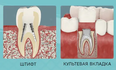 Керамическая вкладка E-max на зуб, цена в Москве