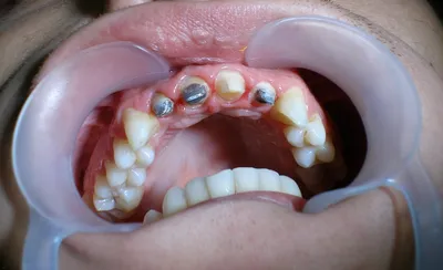 Факты, о которых стоит знать при установке зубной коронки | Стоматология  Smile-at-Once | Дзен