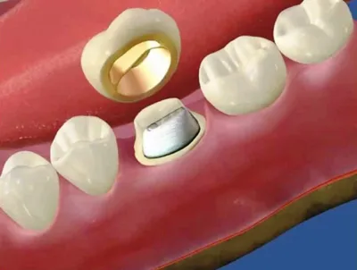 Зубные вкладки в стоматологии, что это такое и когда показана их установка  | Альянс бьюти-ортопедов, Москва