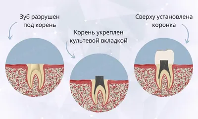 Зубные вкладки на зубы вместо пломбы: микро протез, который ставится в зуб,  восстанавливая разрушенную часть