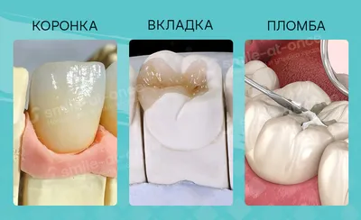 Восстановительные вкладки на зубы. Технология восстановления зубов, их цены  в Москве.