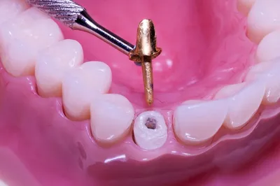 Как ставят коронку на зуб: подробные этапы процедуры установки зубной  коронки в стоматологии
