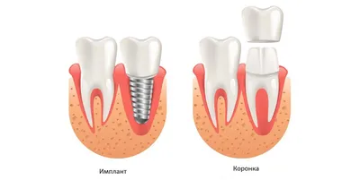 8 вопросов и ответов о зубных коронках. Все, что нужно о них знать |  Стоматология Smile-at-Once | Дзен