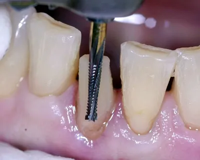 Восстановление зубов вкладками и коронками