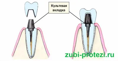 Культевые вкладки: виды, когда применяются, технология изготовления, плюсы  и минусы