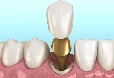 Вкладка на зуб: цена в Москве на установку культевой зубной вкладки под  коронку, протезирование в стоматологии
