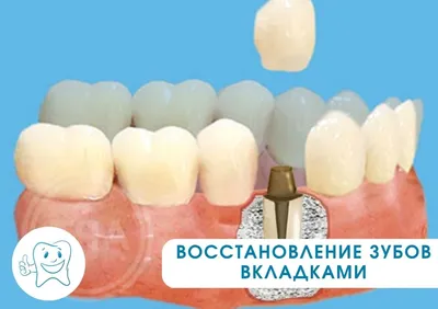 Культевые вкладки в зуб для установки коронок | Стоматологические услуги в  Троицке, Москва