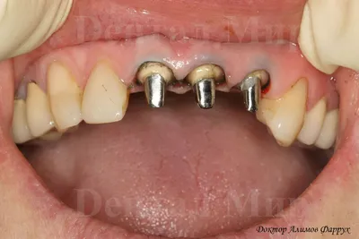Фотография работы по восстановлению сломанного зуба с помощью безметалловой  коронки