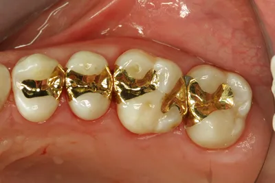 Коронки на зубы в Краснодаре - стоимость установки коронок по низким ценам